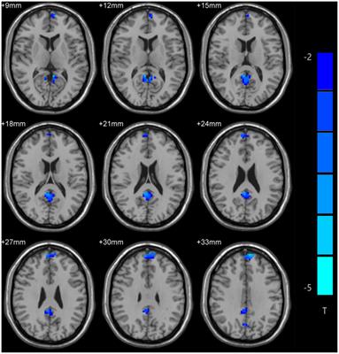 Abnormal amplitude of low-frequency fluctuation values as a neuroimaging biomarker for major depressive disorder with suicidal attempts in adolescents: A resting-state fMRI and support vector machine analysis